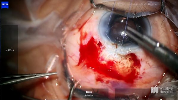 Phacoemulsification, Bleb Excision, and Tube Shunt Surgery thumbnail