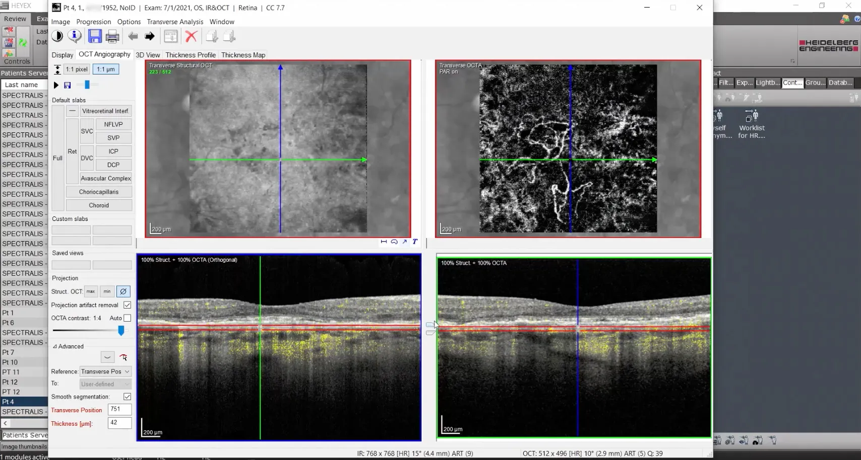 Segmentation Cnv Variable Segmentation on Eyes With CNV with SPECTRALIS - Eyetube