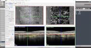 Variable Segmentation on Eyes With CNV with SPECTRALIS