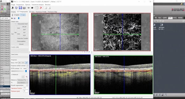 Variable Segmentation on Eyes With CNV with SPECTRALIS thumbnail