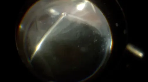 Candida Endophthalmitis