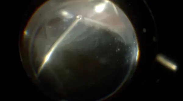 Candida Endophthalmitis thumbnail