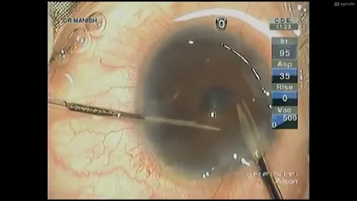 Modified Iris Repair Techniques