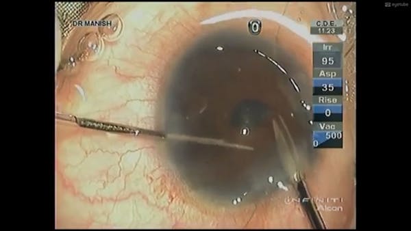 Modified Iris Repair Techniques thumbnail