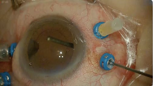 Retinal Detachment & Thick Choroid