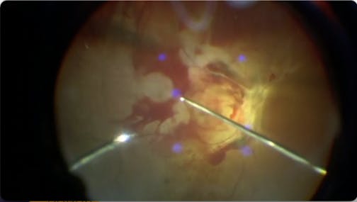 Peeling Under Silicone Oil