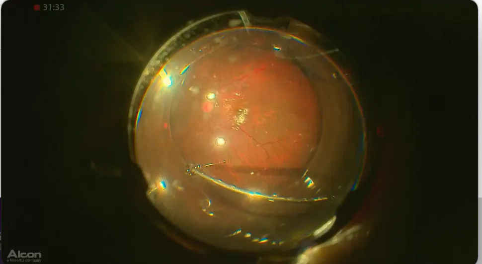 Yellow Filter & Air/Fluid Exchange - Eyetube