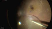 Large Macular Hole