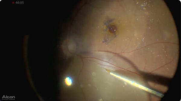 Large Macular Hole thumbnail