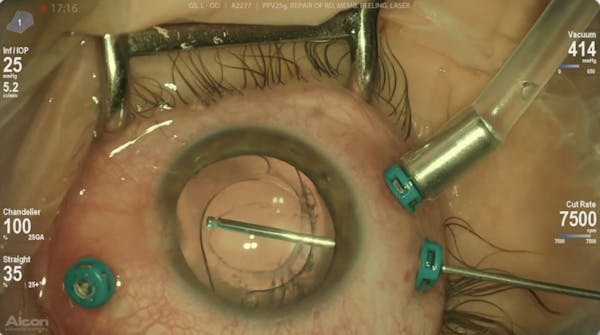 Iatrogenic Break thumbnail