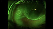 Scleral Buckle