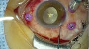 Washing the Hyphema