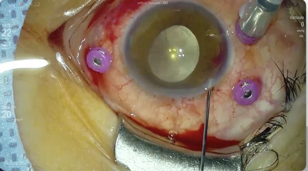 Washing the Hyphema thumbnail