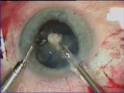 Traumatic Cataract