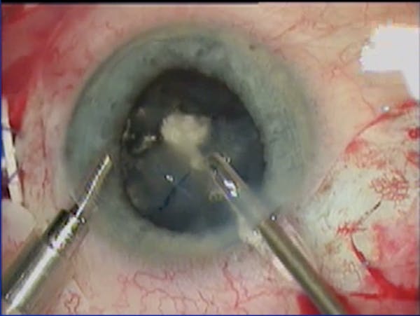 Traumatic Cataract thumbnail