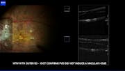 Myopic Foveoschisis