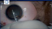 Coloboma