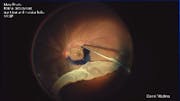 Giant Tear Detachment & Macular Hole