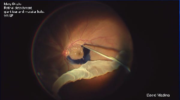 Giant Tear Detachment & Macular Hole thumbnail