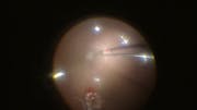 Autologous Transplantation