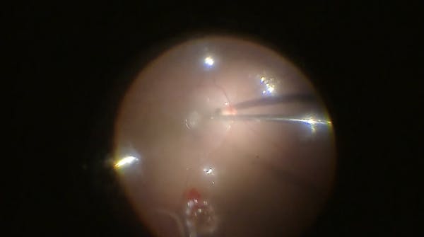 Autologous Transplantation thumbnail