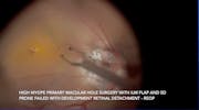 Myopic Macular Hole Detachment