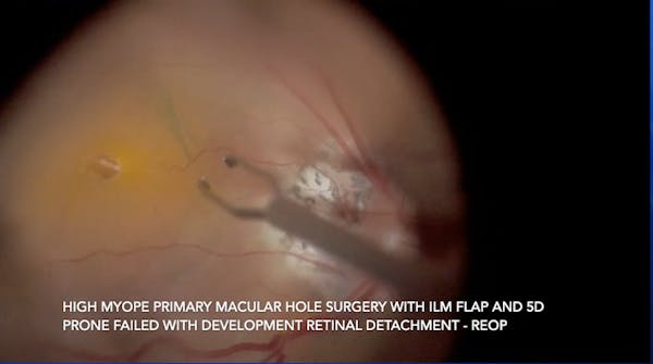 Myopic Macular Hole Detachment thumbnail