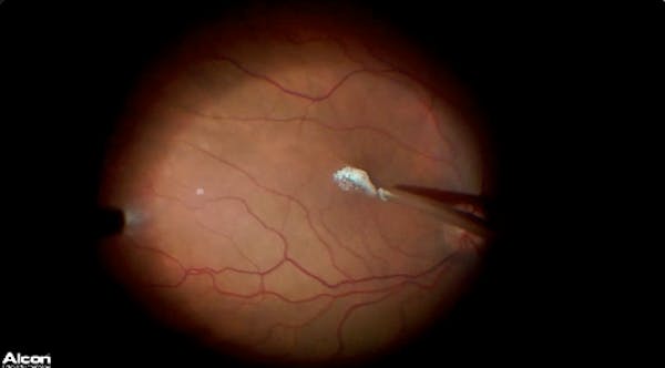 Macular Hole thumbnail
