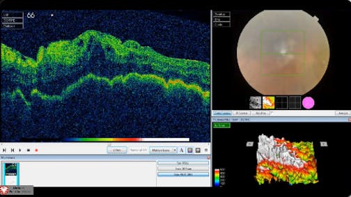 Persistent Choroidal Detachment