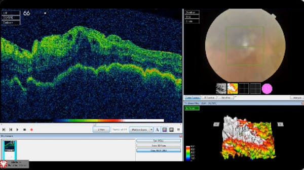 Persistent Choroidal Detachment thumbnail