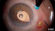 Subluxated IOL