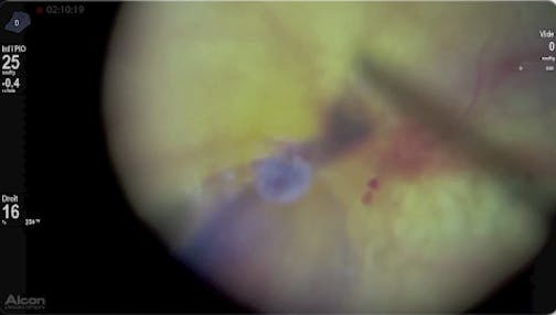 Digital Filters & Peeling