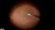 Macular Hole