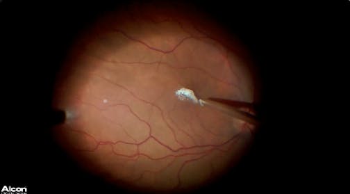 Macular Hole