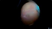 Subretinal Peeling