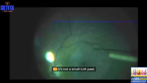 Ep.11 Part 3: Yasha Modi   |   Video Case: Using Induced Macular Detachment as a Tool for Macular Hole Repair