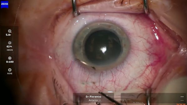 Susvimo: Surgical Pearls & Tricks #1 (Peritomy) thumbnail