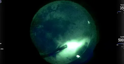 Vitreoretinal Surgery With Intraoperative Fluorescein Angiography
