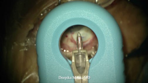 Susvimo: Preparing the Implant