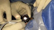 Scleral Buckling
