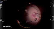 Macular Hole & Diabetic Vitrectomy