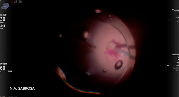 Macular Hole & Diabetic Vitrectomy thumbnail