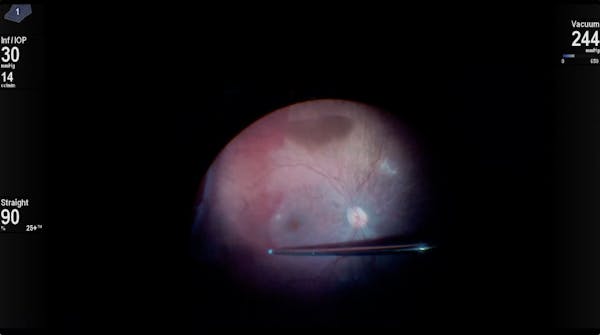 Stickler Syndrome thumbnail