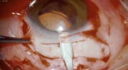 Marfan Syndrome