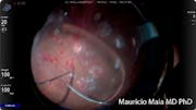 Diabetic Dissection