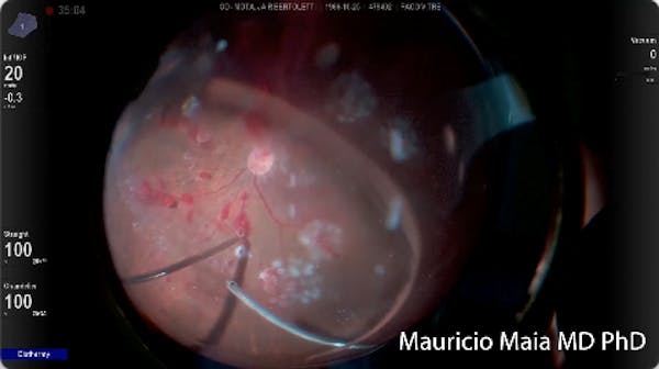 Diabetic Dissection thumbnail