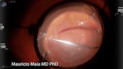 Retinal Detachment