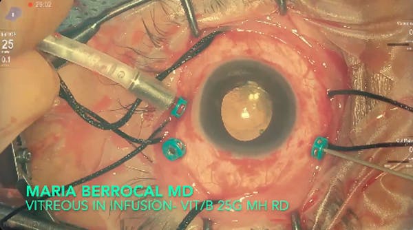 Infusion thumbnail