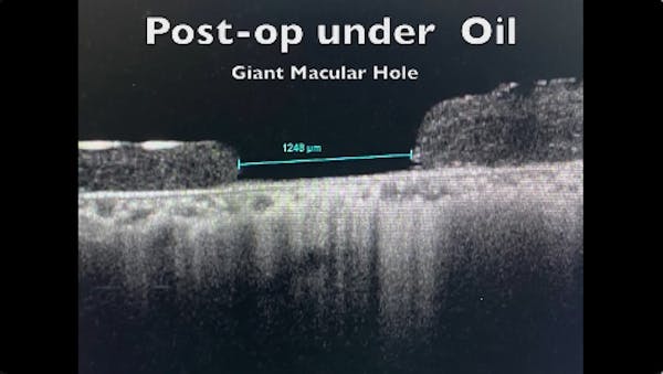 Amniotic Membrane thumbnail
