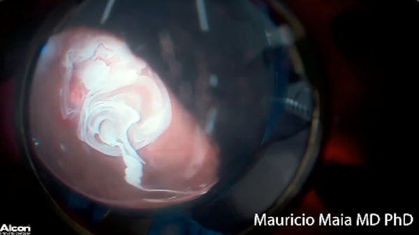 Abnormal Hyaloid thumbnail